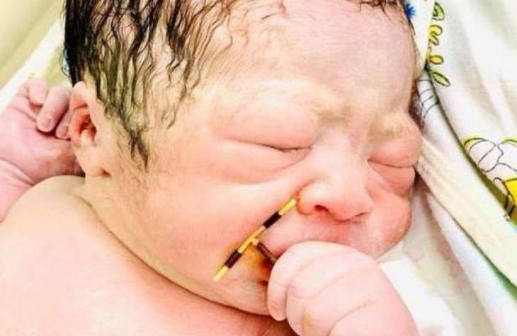 Bebê nasce segurando o dispositivo intrauterino (DIU) da mãe e foto viraliza