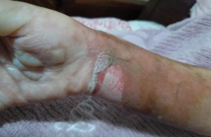 Celular que estava carregado explode e menina de 5 anos sofre queimaduras de 2º grau.