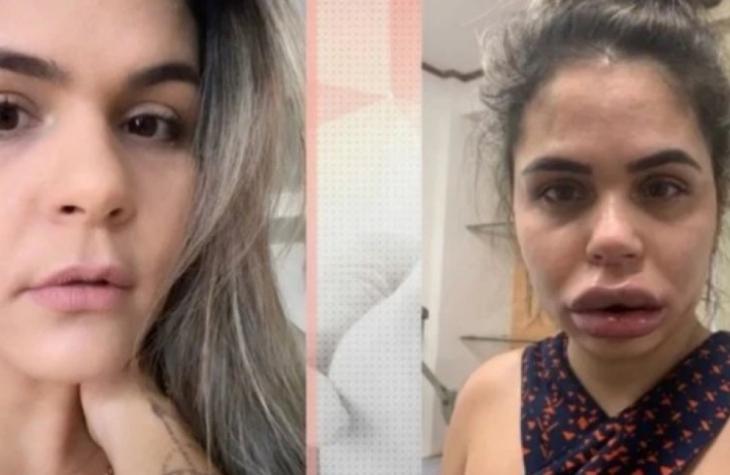 Dentista é acusada de deformar rosto de mulheres após harmonização facial